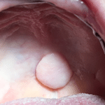 neurofibroma1