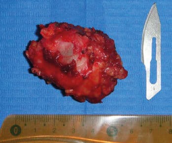 Figura 4. Pieza quirúrgica resultado de la exéresis de la lesión (4,5 x 3,5 cm).
