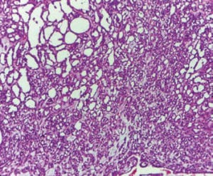 Figura 4. Microfotografía 40x H/E. CEM Lesión tumoral con área central celular en forma de estructuras tubulares rodeada de estroma hialinizado.