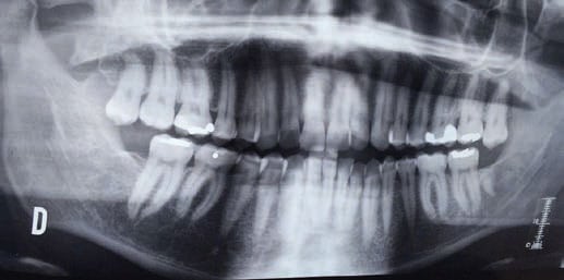 Figura 3. Radiografía panorámica en la que se observa la extrusión del 28.