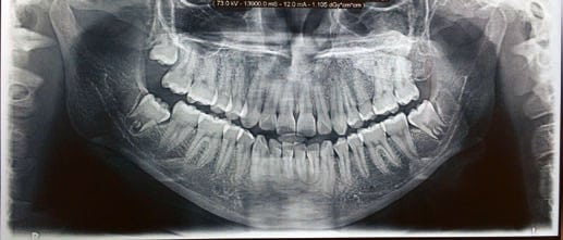 Foto 23. Ortopantomografía a los dos años de la cirugía de la recidiva.