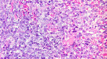 Microfotografía 40x H/E. LNH donde se pueden observar a mayor aumento células linfoides grandes con núcleos pleomórficos y nucleólos prominentes. Se pueden observar muchas mitosis.(Figura 5) 