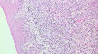 Microfotografía 10x H/E. LNH. Proliferación células linfoides grandes. (Figura 4) 