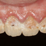 Arcada-superior-frontal-zona-anterior.-Estado-inicial.