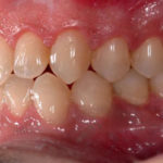 Arcada-superior-lado-derecho-zona-posterior.-Realizado-el-tratamiento-.