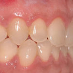 Arcada-superior-lado-derecho-zona-posterior.-Realizado-el-tratamiento.