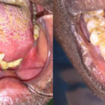 Ulceración-dolorosa-en-zona-alveolar-mandibular-con-movilidad-dentaria-y-consistencia-indurada-a-la-palpación.-(Figuras-1-y-2)