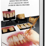claves-protesis-fija.ceramica