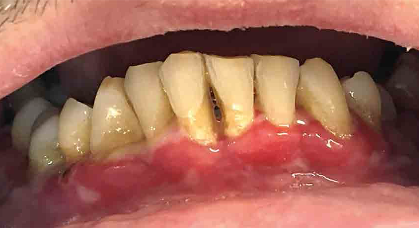Lesiones en encía vestibular mandibular  (Figura 2)