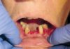 Gingivitis descamativa en encía adherida. (Figura 3)