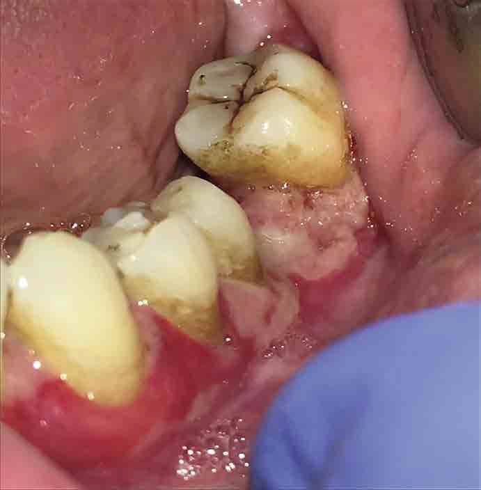 Lesiones ulcerativas en encía queratinizada vestibular (Figura 3)