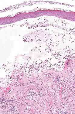 Imagen histológica x10 con tinción Hematoxilina-Eosina de una ampolla subepidérmica, que presenta celularidad inflamatoria con frecuentes eosinófilosen la cavidad de la ampolla y dermis con infiltrado linfocitario de distribución perivascular, con abundantes eosinófilos perivasculares e intersticiales. (Figura 5)