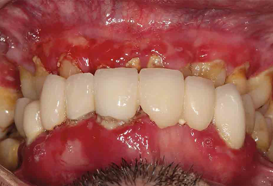 Gingivitis y detritus (Figura 5) 