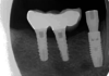 Radiografía periapical de diente 44 con corona protésica (Figura 1).