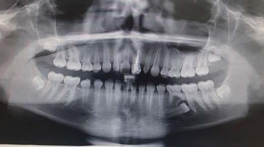 Fig 1. Rx panorámica con imagen radiotransparente bien deﬁ nida asociada al segundo premolar inferior incluido izquierdo.