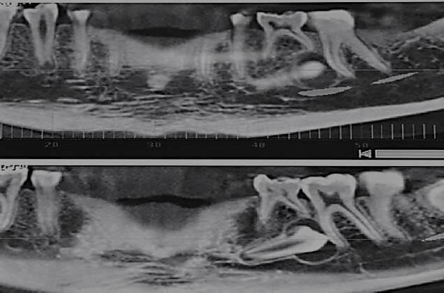 Fig 2. Corte panorámico que muestra la extensión mesio-distal de la lesión.