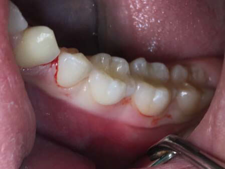 Fig 4. Incisión surcular desde el primer premolar hasta distal del primer molar inferior izquierdo con su descarga.