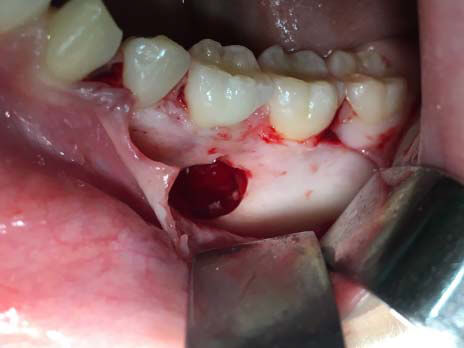 Fig 6. Ostectomía con extirpación de la totalidad de la lesión y su posterior extracción 35.