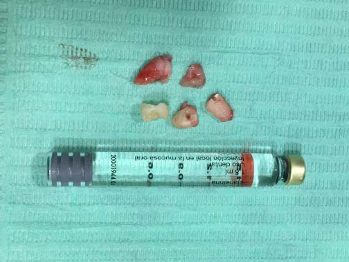 Fig 7. Contenido de la lesión y restos de la osteotomía del 35.