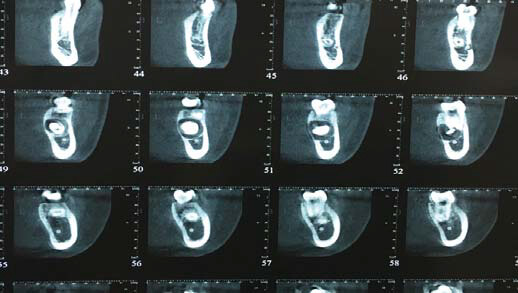 Fig 3. Cortes ortorradiales que muestran la cercanía con las raíces mesiales del 36, la extensión apical con respecto al nervio dentario inferior izquierdo y la vestíbulo-palatina de la lesión.