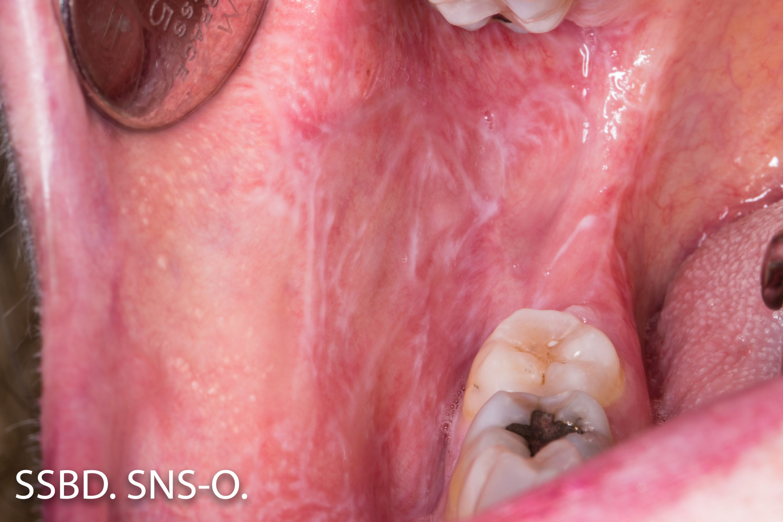 Liquen plano reticular Odontologos de Hoy Liquen plano reticular Odontologos de Hoy