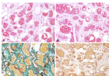 Radiolucidez periapical: No siempre es un quiste, ni es odontogénica ni secundaria a pulpitis