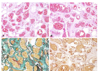 Radiolucidez periapical: No siempre es un quiste, ni es odontogénica ni secundaria a pulpitis