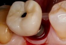 Interacción entre factores protésicos y sistémicos en la periimplantitis